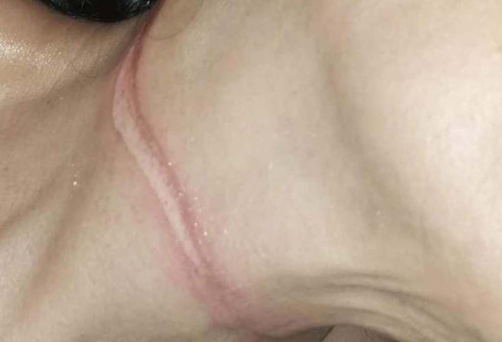 Nyaris Tewas, Pengendara Motor Terjerat Kabel FO Biznet di&nbsp;Singosari